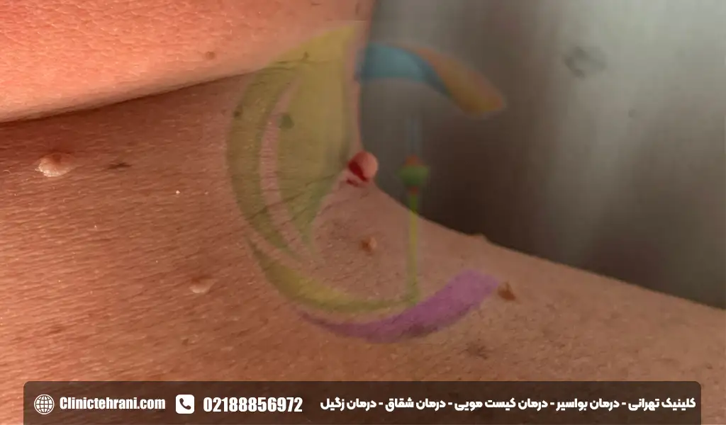 علائم زگیل