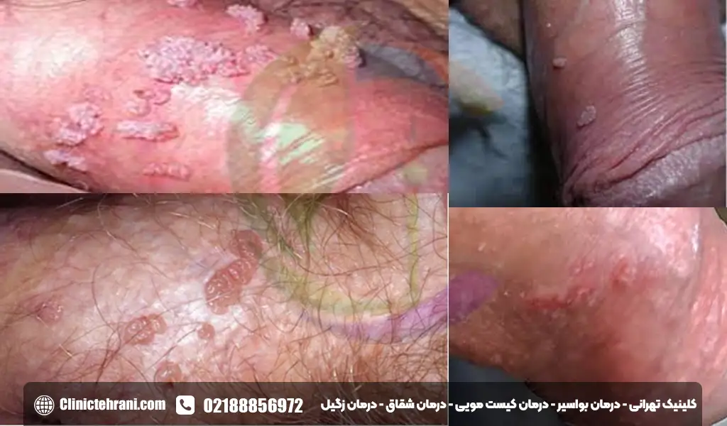 علائم زگیل تناسلی