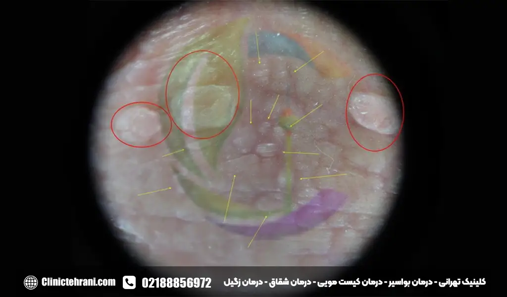 علائم زگیل تناسلی داخل واژن
