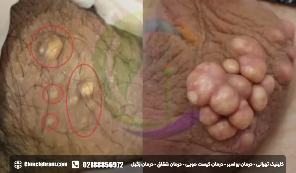 توده سفت زیر پوست در ناحیه تناسلی مرد