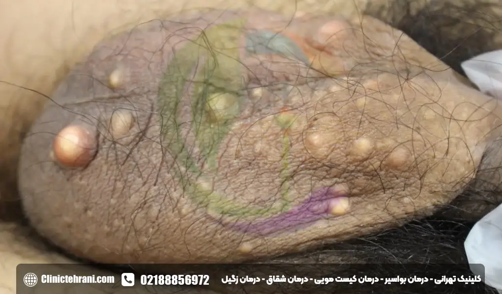 توده کروی در زیر پوست اندام تناسلی