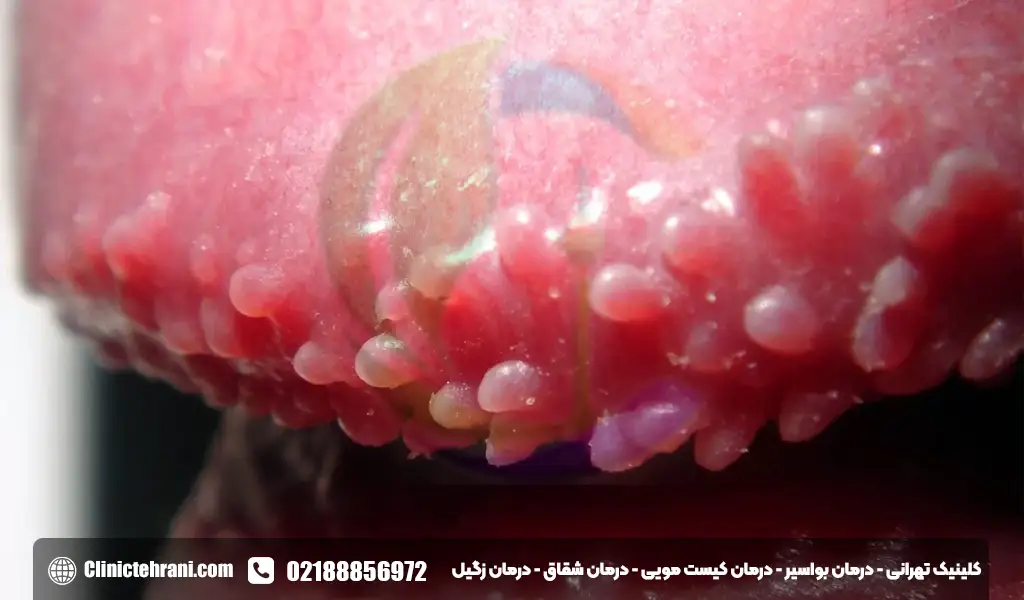 توده تناسلی چیست