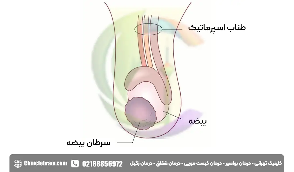 توده تناسلی در مردان