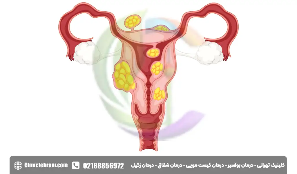 توده تناسلی