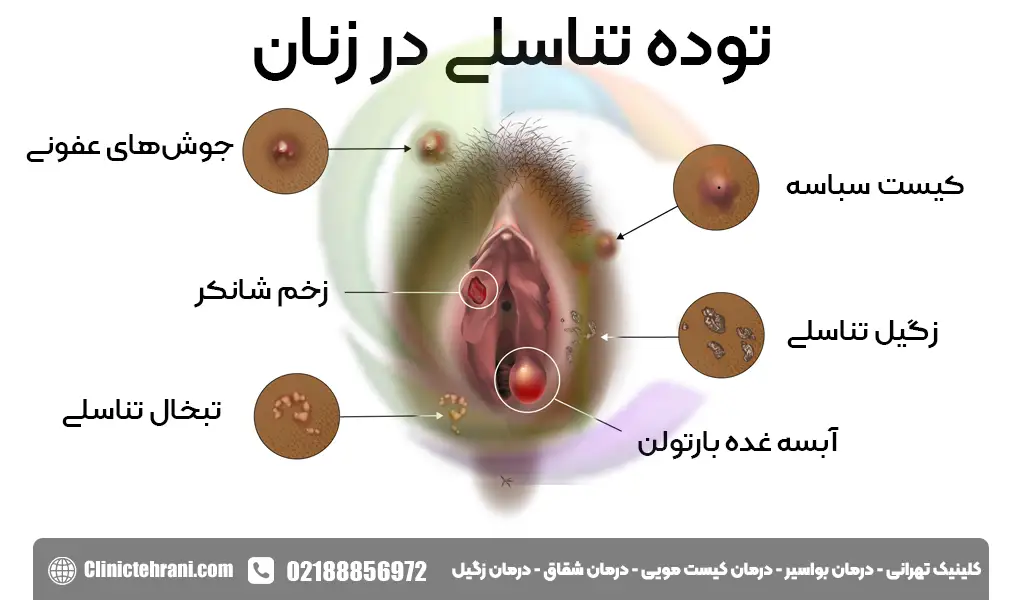 توده تناسلی در زنان