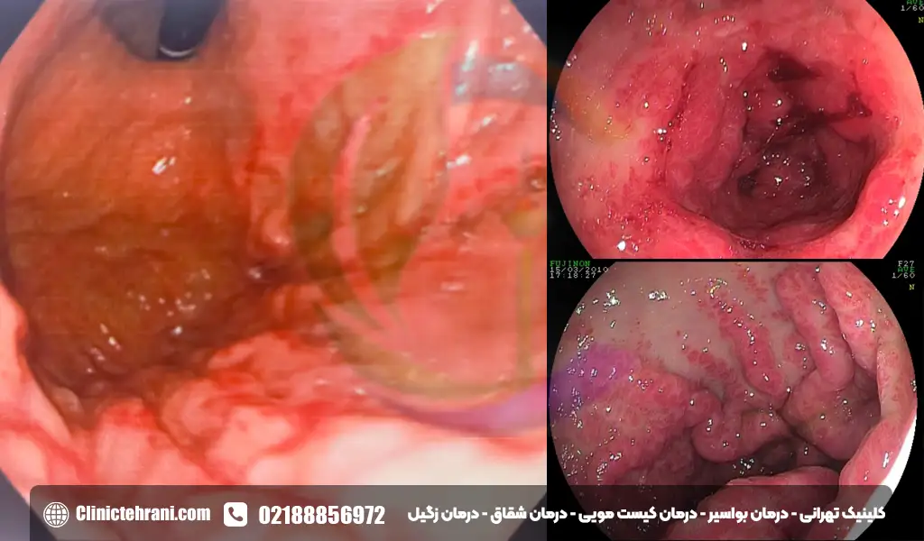 عکس ورم معده در آندوسکوپی
