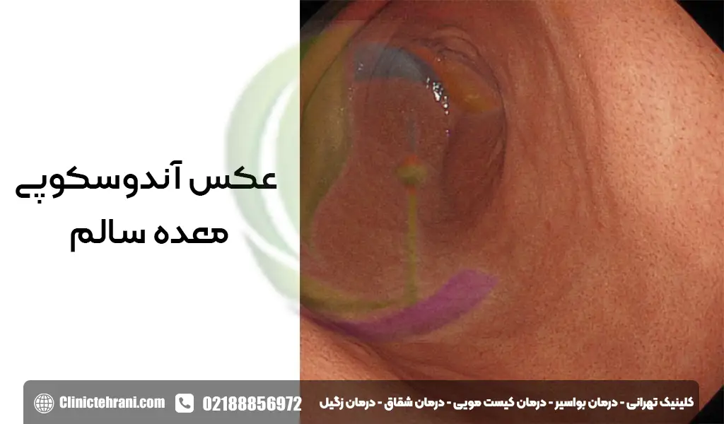 عکس آندوسکوپی معده سالم