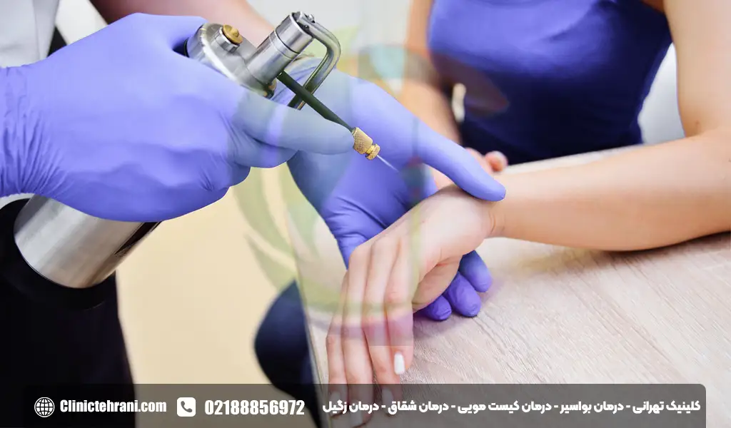 درمان زگیل با فریز کردن
