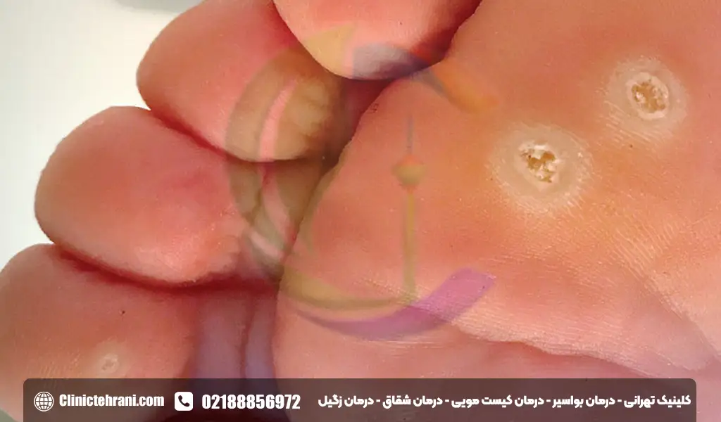 میخچه کف پا