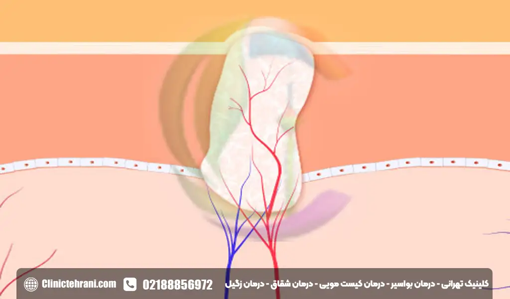 زگیل چیست
