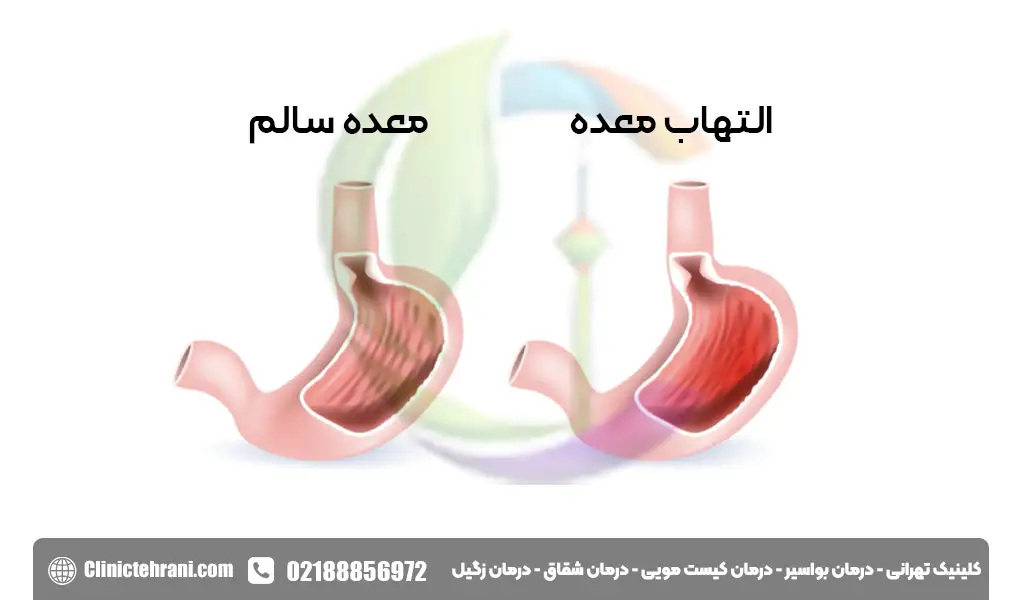 ورم معده