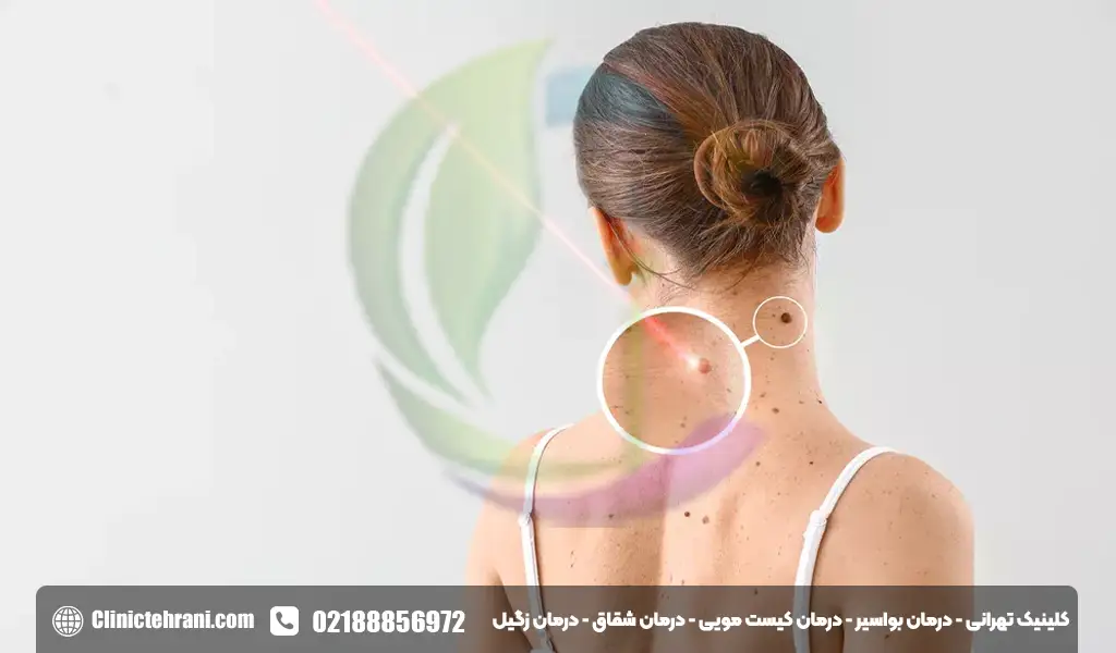 لیزر زگیل تناسلی در بارداری