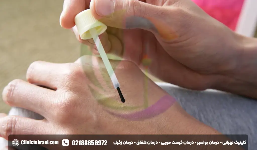 درمان خانگی زگیل تناسلی در بارداری