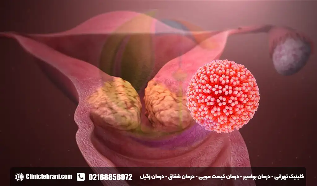 سرطان دهانه رحم