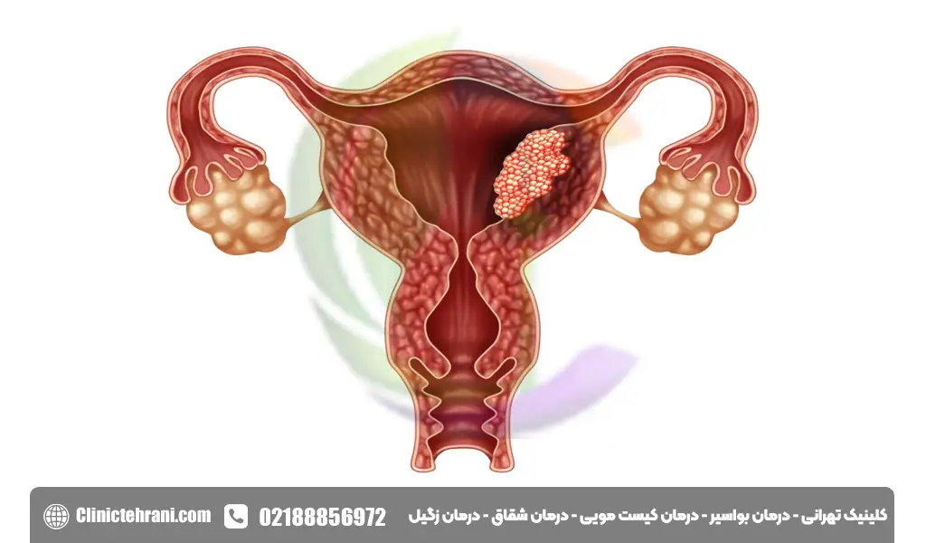 علائم سرطان رحم