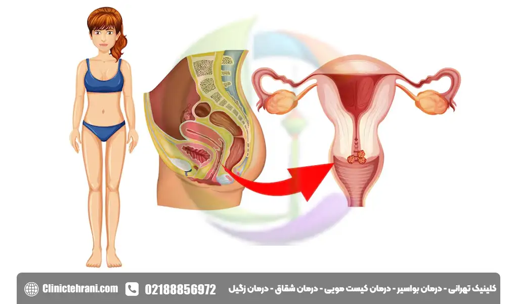 زخم دهانه رحم