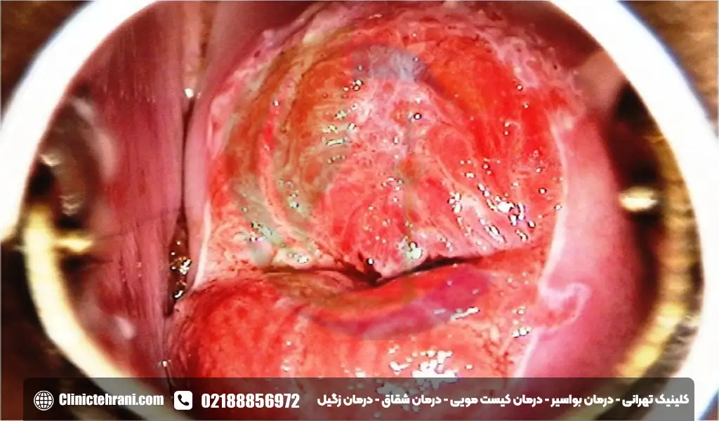 عکس زخم دهانه رحم